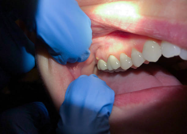 Best Emergency Treatment for Dental Infections or Abscesses in Collierville, CA